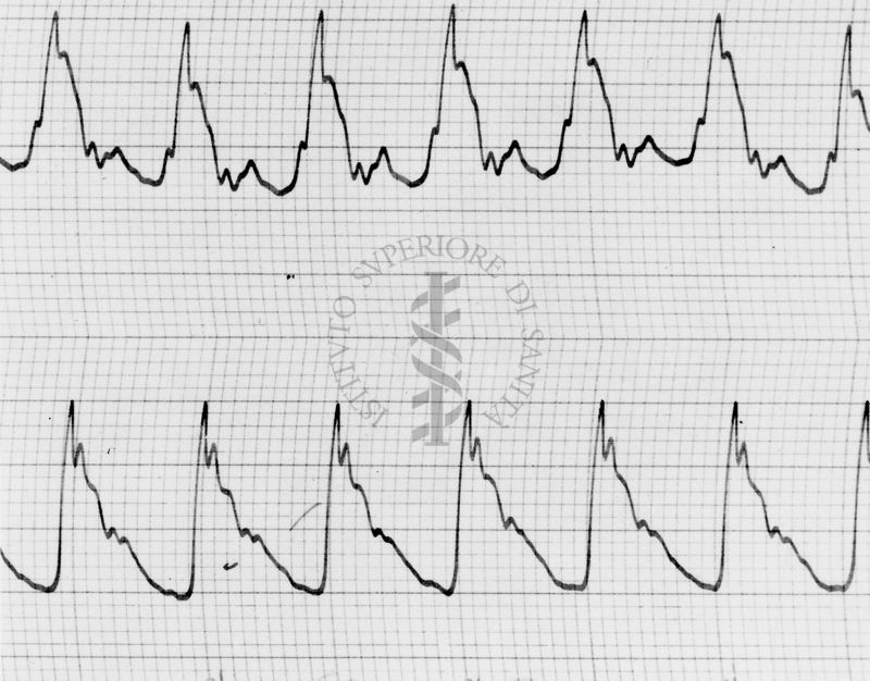 Sfigmogrammi sull'apertura e chiusura dei vasi sanguigni