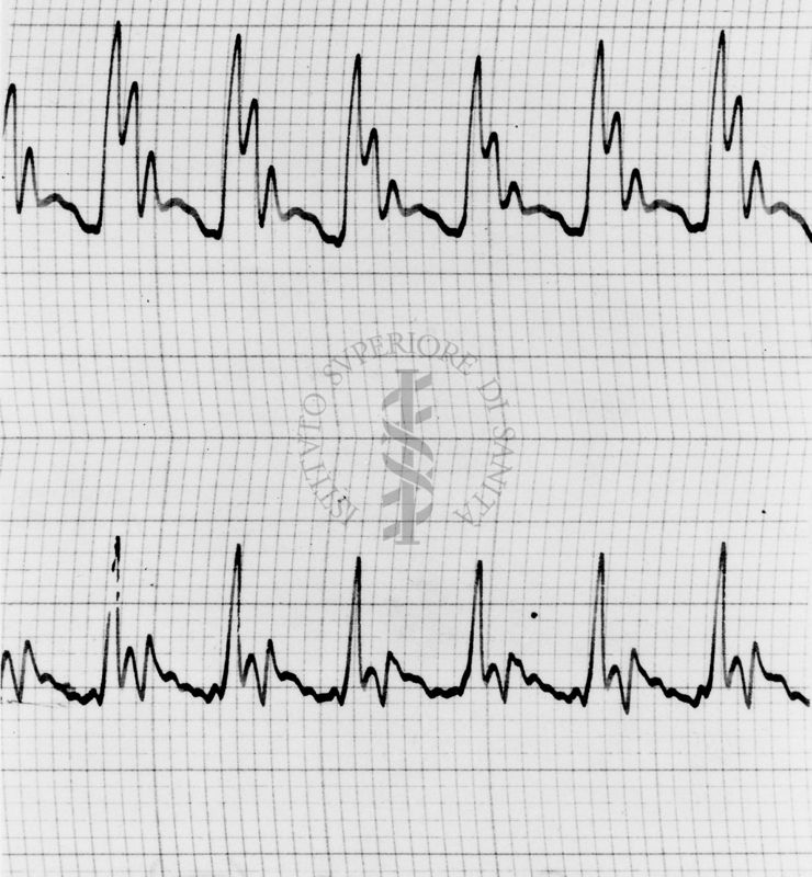 Sfigmogrammi sull'apertura e chiusura dei vasi sanguigni