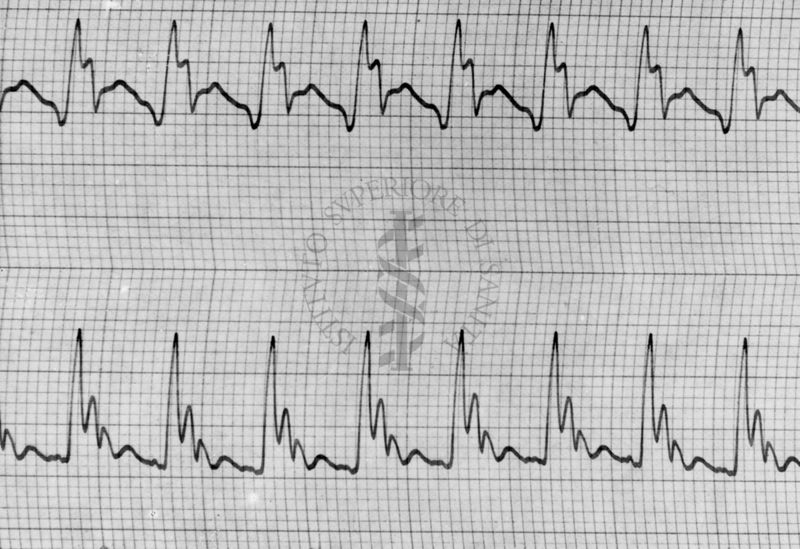 Sfigmogrammi sull'apertura e chiusura dei vasi sanguigni