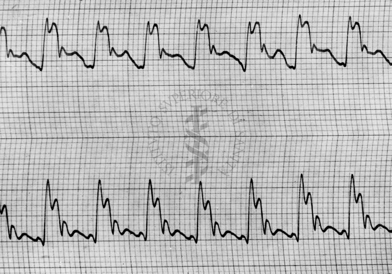 Sfigmogrammi sull'apertura e chiusura dei vasi sanguigni