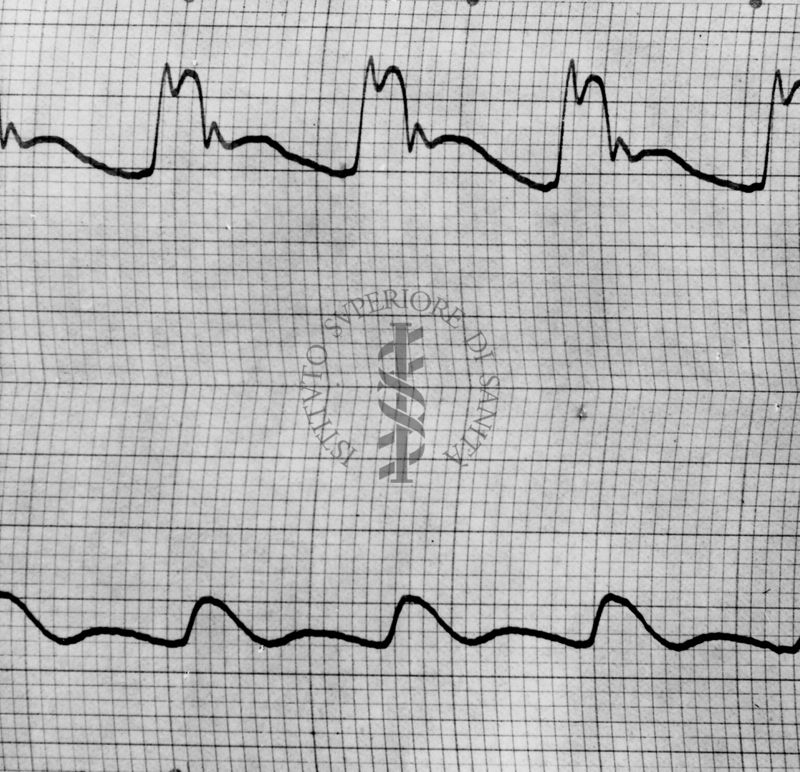 Sfigmogrammi sull'apertura e chiusura dei vasi sanguigni