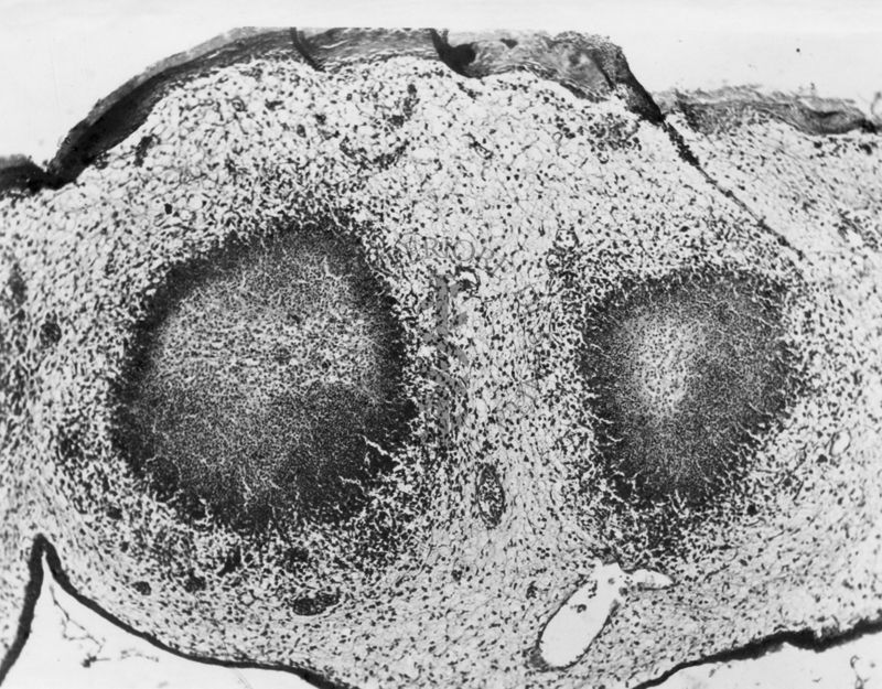 Tubercolosi aviaria sulla membrana corion allantoidea dei polli - micro fotografia originale 80 ingr.