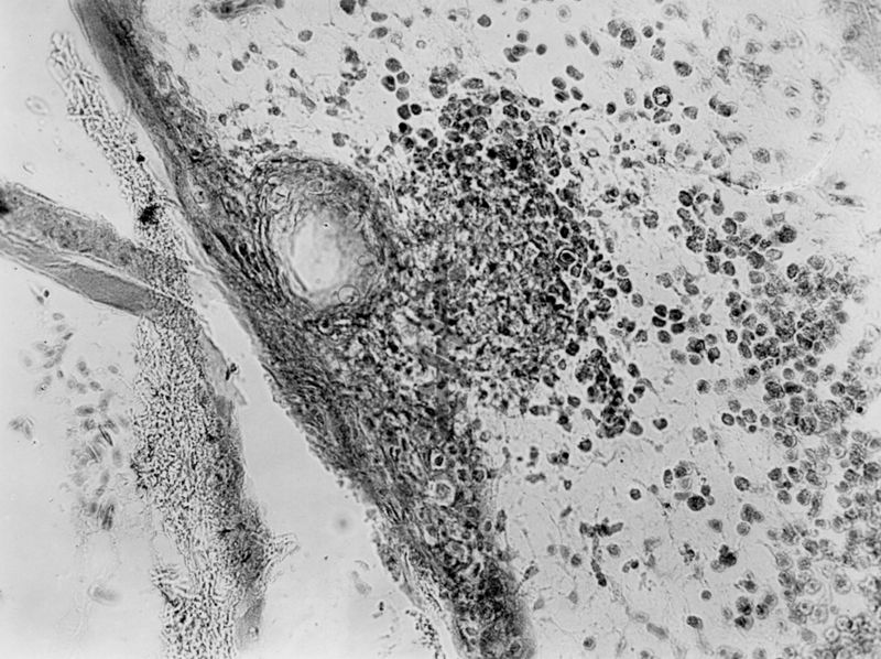 Tubercolosi aviaria sulla membrana corion allantoidea dei polli - micro fotografia originale 320 ingr.