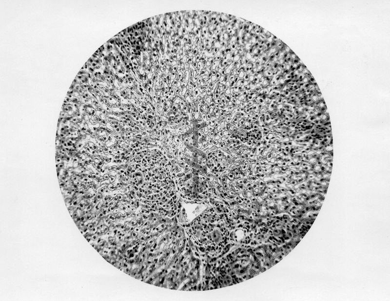 Micobatteri (Battaglini) Fegato-focolaio granulomatoso e degenerazione grassa - micro fotografia originale ingr. 155