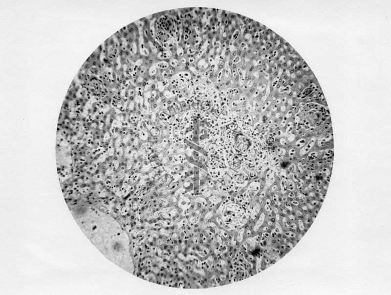 Micobatteri (Battaglini) Fegato-infiltrati granulomatosi - micro fotografia originale ingr. 110