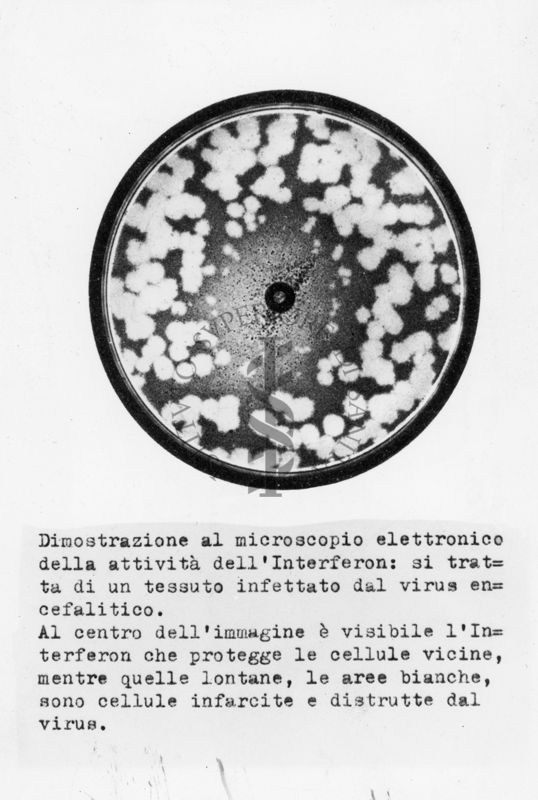 Descrizioni sulla foto: Dimostrazione al microscopio elettronico della attività dell'Interferon: si tratta di un tessuto infettato dal virus encefalico. Al centro dell'immagine è visibile l'Interferon che protegge  le cellule vicine, mentre quelle lontane, le aree bianche, sono cellule infarcite e distrutte dal virus.