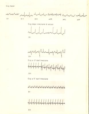 Elettrocardiogramma sull'azione dell'alcol etilico sul cuore di coniglio