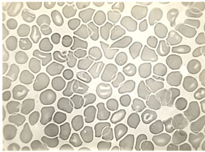 Globuli rossi maculati nella Malaria