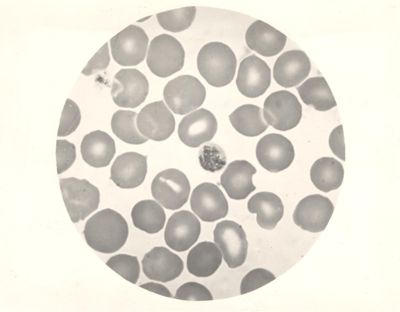 Plasmodium malariae