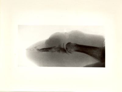 Radiografia del dito pollice della mano sinistra del Sig. Ugo Lustrissimi, affetto da notevole atrofia lacunare diffusa, con zona ossea iperopaca riferibile a "sequestro osseo" (osteomielite)
