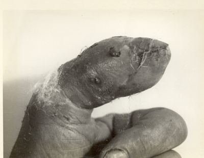 Dito pollice della mano sinistra del Sig. Ugo Lustrissimi, affetto da osteomielite, fotografato prima e dopo il trattamento con la penicillina