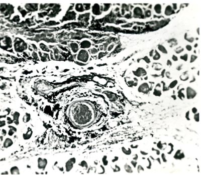 Necrosi di una parete di vaso nella zona di un flemmone muscolare nel coniglio 48 ore dopo l'infezione. Masse di streptococchi intorno al vaso