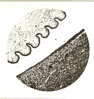 Sarcoma da Cystiarcus fasciolaris