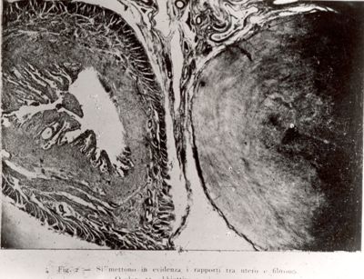 Micro fotografia riguardante l'evidenza i rapporti tra utero e fibroma.
