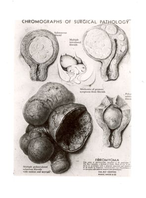 Fibroma dell'utero