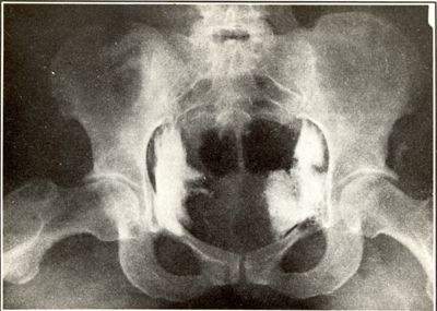 Radiografia dimostrante la distribuzione dell'oro nel bacino umano