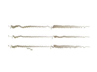 Grafico originale registrante il nistagmo del coniglio