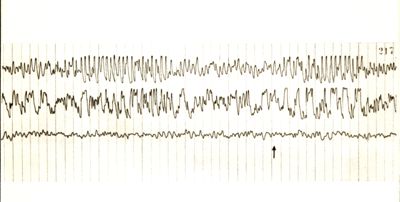 Grafici relativi all'elettroencefalogramma di coniglio