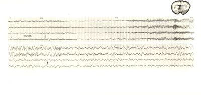 Tracciati elettroencefalografici di coniglio