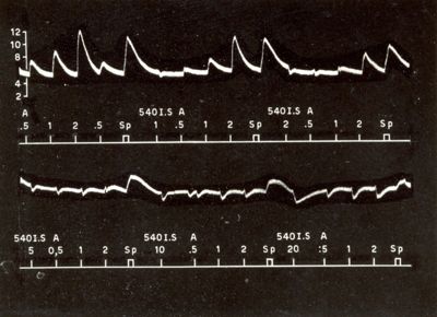Grafici raffiguranti l'azione sulla pressione arteriosa del cane da simpatolitici di sintesi (derivati dell'ergotammina)