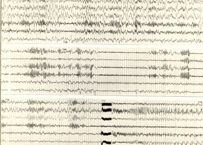 Tracciati elettroencefalografici