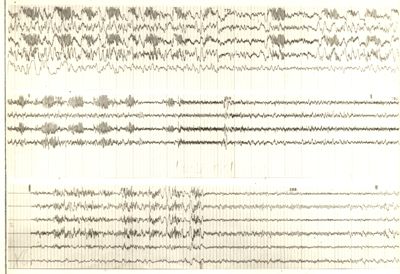 Tracciati elettroencefalografici di coniglio