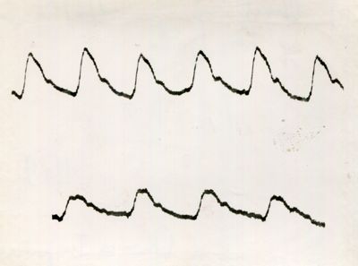 Registrazione piezografica del polso dell'arteria temporale nell'uomo sotto effetto di vari farmaci