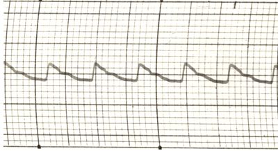 Polsazioni delle arterie nell'uomo