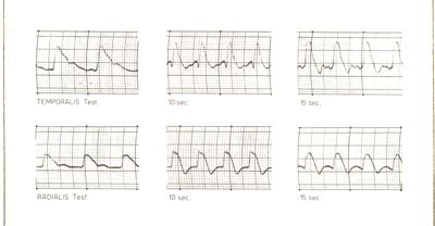 Registrazioni delle pulsazioni dell'arteria temporale nell'uomo sotto azione di vari farmaci
