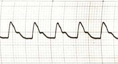 Piezosfigmogrammi delle principali arterie dell'uomo