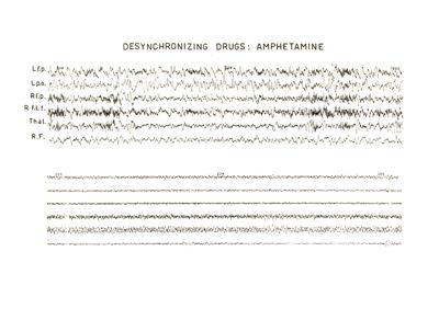 Azione della Anfetamina sull'E.E.G.