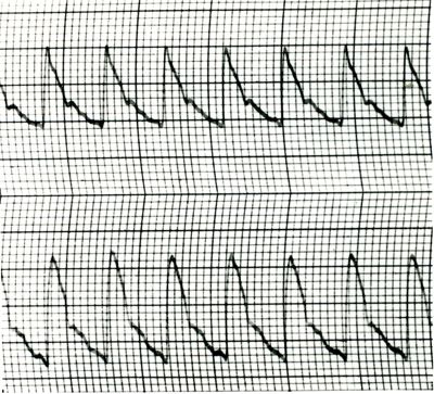 Piezosfigmogrammi di arterie temporali umane sotto attacchi emicranici