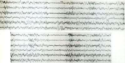 Tracciati elettroncefalografici di coniglio