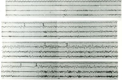 Tracciati elettroencefalografici di coniglio