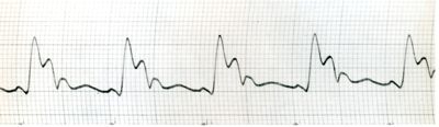 Sfigmogrammi dell'Aorta toracica