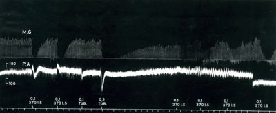 Azione della tubocurarina verso il 370 I.S.