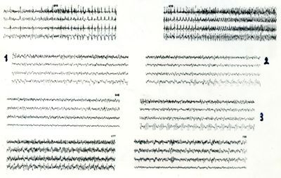 Azione elettroencefalografica della stricnina