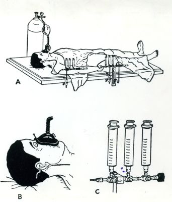 Tecnica di Kety per circolazione cerebrale