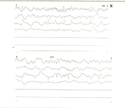 Tracciati elettroencefalografici di coniglio