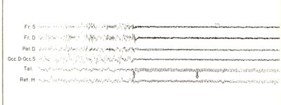 Tracciati elettroencefalografici