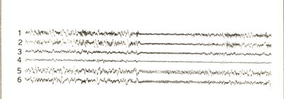 Tracciati elettroencefalografici