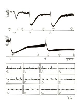 Tracciati elettroencefalografici