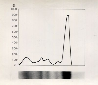Grafico riguardante lo studio sulle proteine seriche in soggetti portatori di neoplasie trattati con raggi X.