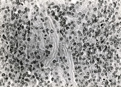 Alterazioni renali in topino lattanyte da virus Coxsackie.