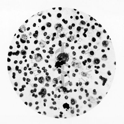 Plasmodium gallinaceum: midollo osseo, cellule istiocitarie con forme di sviluppo del parassita