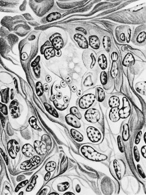 Trypanosoma cruzy: forme a Leishmania in tiroide umana