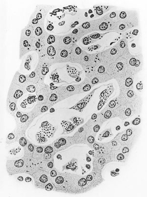 Sezione di fegato umano con Leishmania donovani in macrofagi e in cellule ghiandolari
