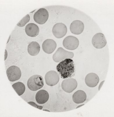 Macrogametocito maturo di Plasmodium vivax