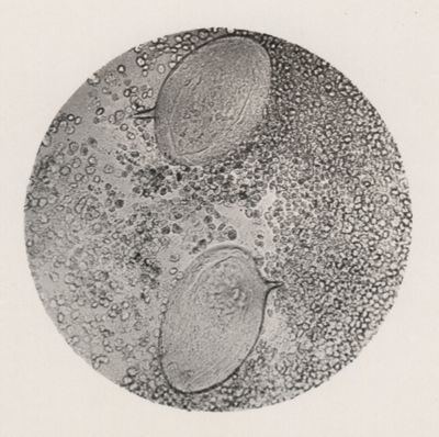 Uova di Schistosoma Mansoni