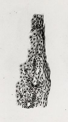 Membrana cistica in un caso di infestazione epatica da cysticercus fasciolaris
